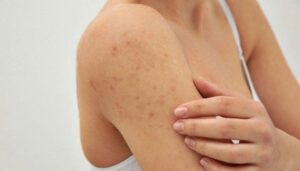 Góc Review: Sản phẩm Follicas - Bí quyết cho nỗi lo viêm nang lông 2 VNL1