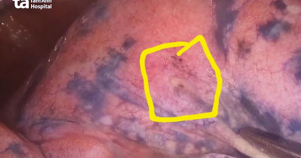 lo ro xi bat thuong tren nguoi dan ong 30 nam hut thuoc la 654ceb8613eb1